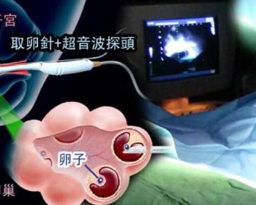 广州传承生殖中心可靠[绝经后还能怀孕],做试管婴儿要打几针