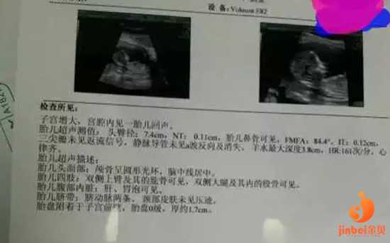 【在广州做供卵试管婴儿供卵试管要等吗】听到胎监里面每次我用力孩子的心跳